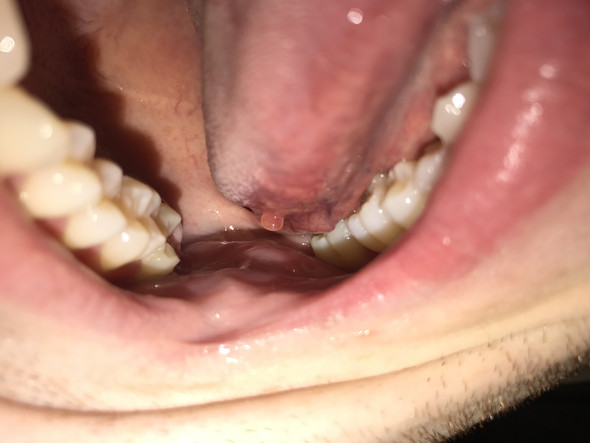 Blase - (Arzt, Zahnarzt, Mund)
