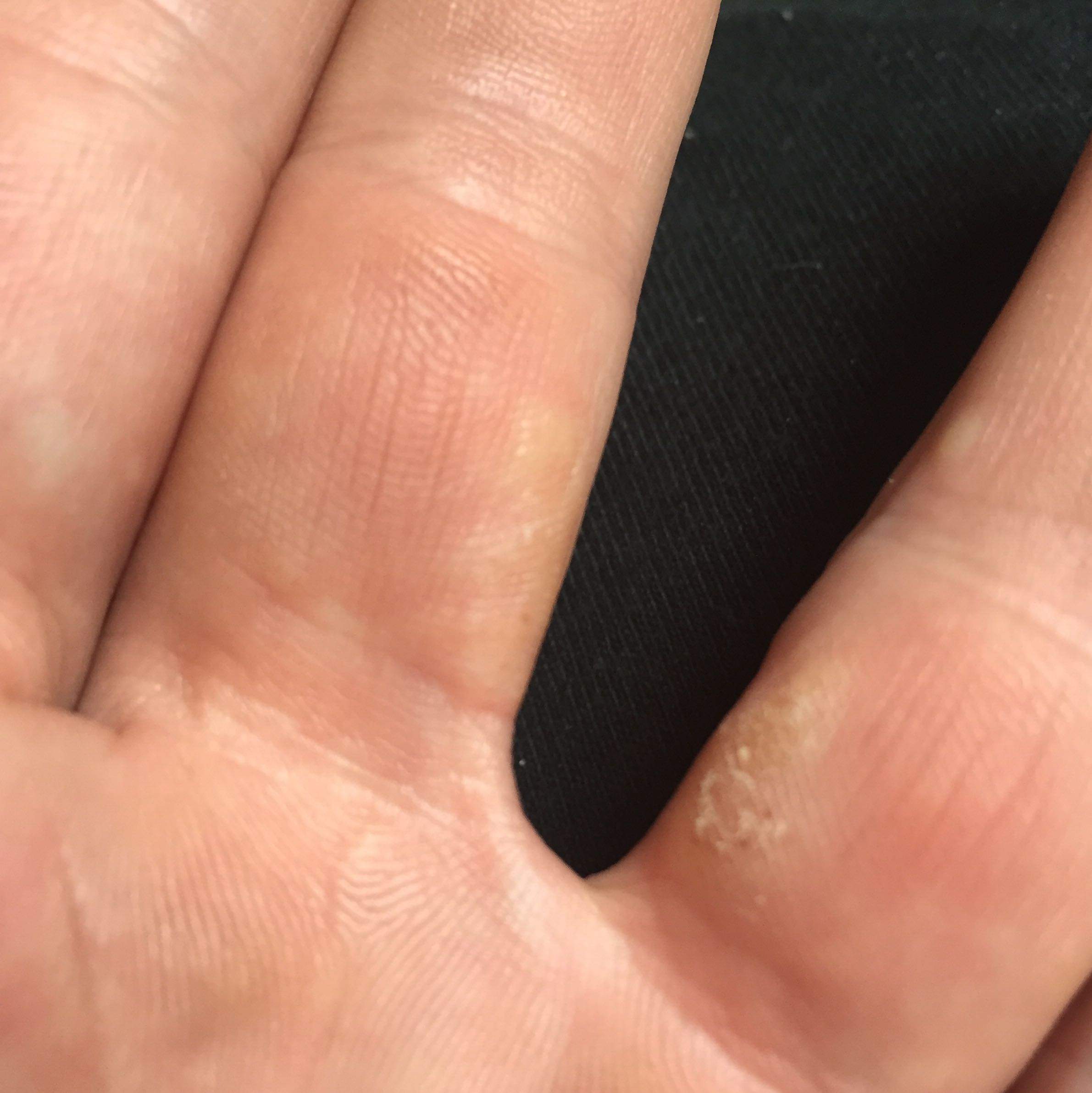 Blasen den den Fingern? (Arzt, Krankheit, Haut)