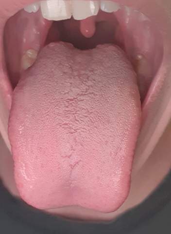 Blasen oder pickel auf der zunge die weh tun? (Mund, Blase) pickel die weh tun