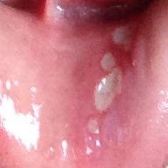 Blasen unter Lippen  - (Schmerzen, Entzündung, Lippe)
