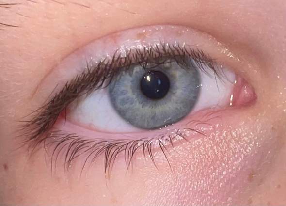 Blau-graue graue oder blau-graue Augen mit gelben/braunen flecken?