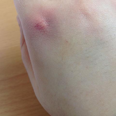 - (Schmerzen, Hand)