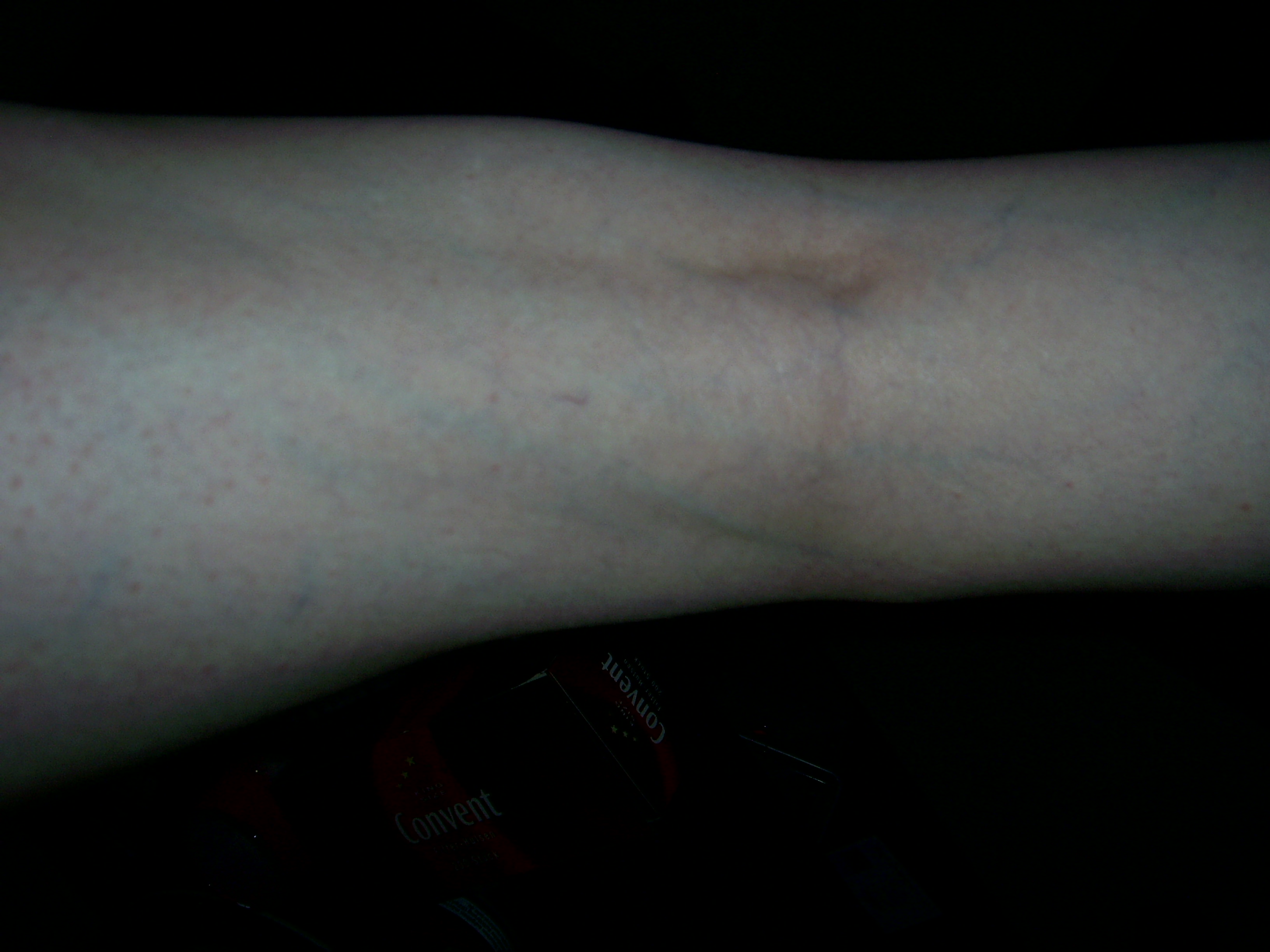 Blaue Adern an der Wade Ist das schlimm? (Gesundheit, Beine)