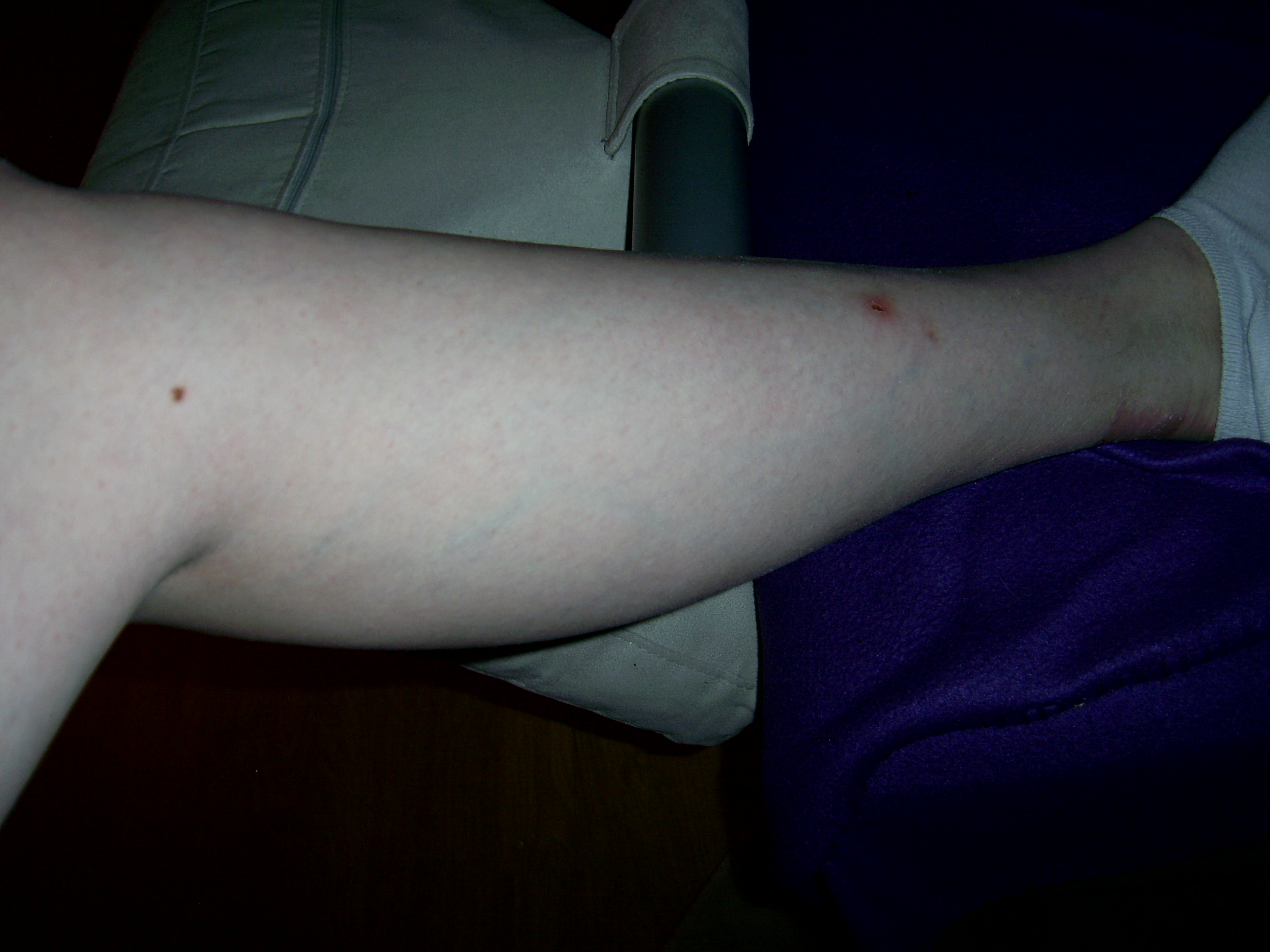 Blaue Adern an der Wade: Ist das schlimm? (Gesundheit, Beine)