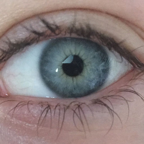 Das ist mein Auge. - (Augen, Operation, braun)