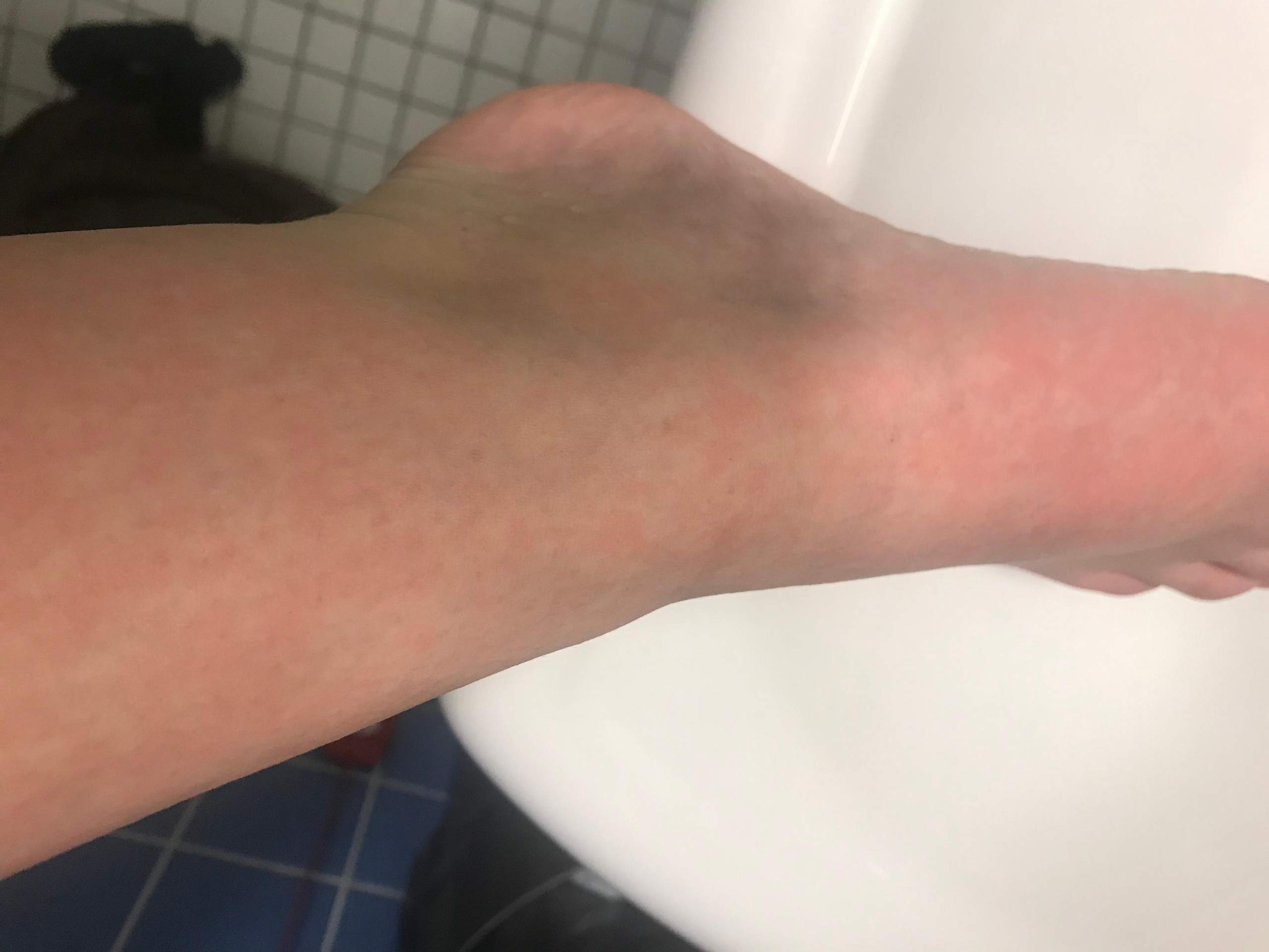 Blaue Beine Mit Roten Flecken Gesundheit Und Medizin Blaue Flecken Blaue Beine Mit Roten Flecken Gesundheit Und Medizin Blaue Flecken