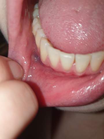 Blaue Blase Innenlippe Was Kann Es Sein Blaue Blase Innenlippe Was Kann Es Sein