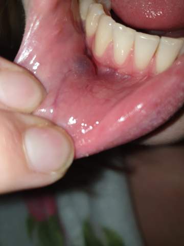 Blaue Blase Innenlippe Was Kann Es Sein Blaue Blase Innenlippe Was Kann Es Sein