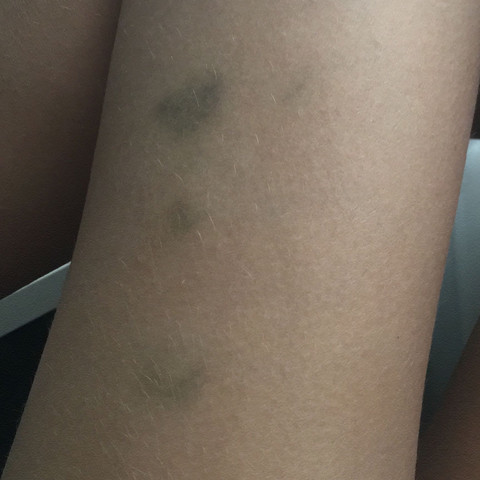 Blaue Flecke Am Bein Ohne Grund Warum Mit Foto Gesundheit Arzt Beine Blaue Flecke Am Bein Ohne Grund Warum Mit Foto Gesundheit Arzt Beine