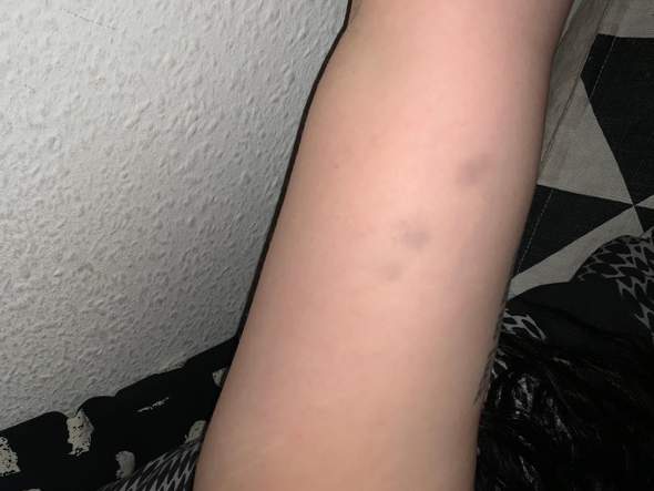 Blaue Flecken Am Arm Gesundheit Und Medizin Blauer Fleck Blaue Flecken Am Arm Gesundheit Und Medizin Blauer Fleck