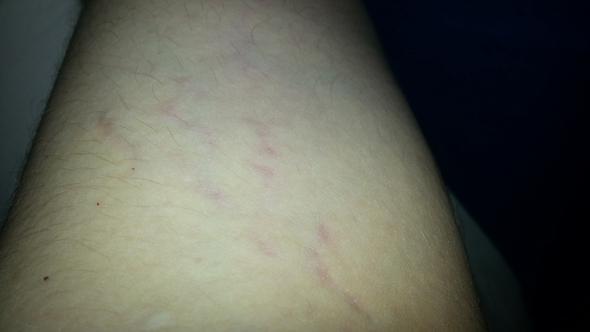 Blaue Flecken am Arm… (Gesundheit, Körper) Blaue Flecken am Arm… (Gesundheit, Körper)