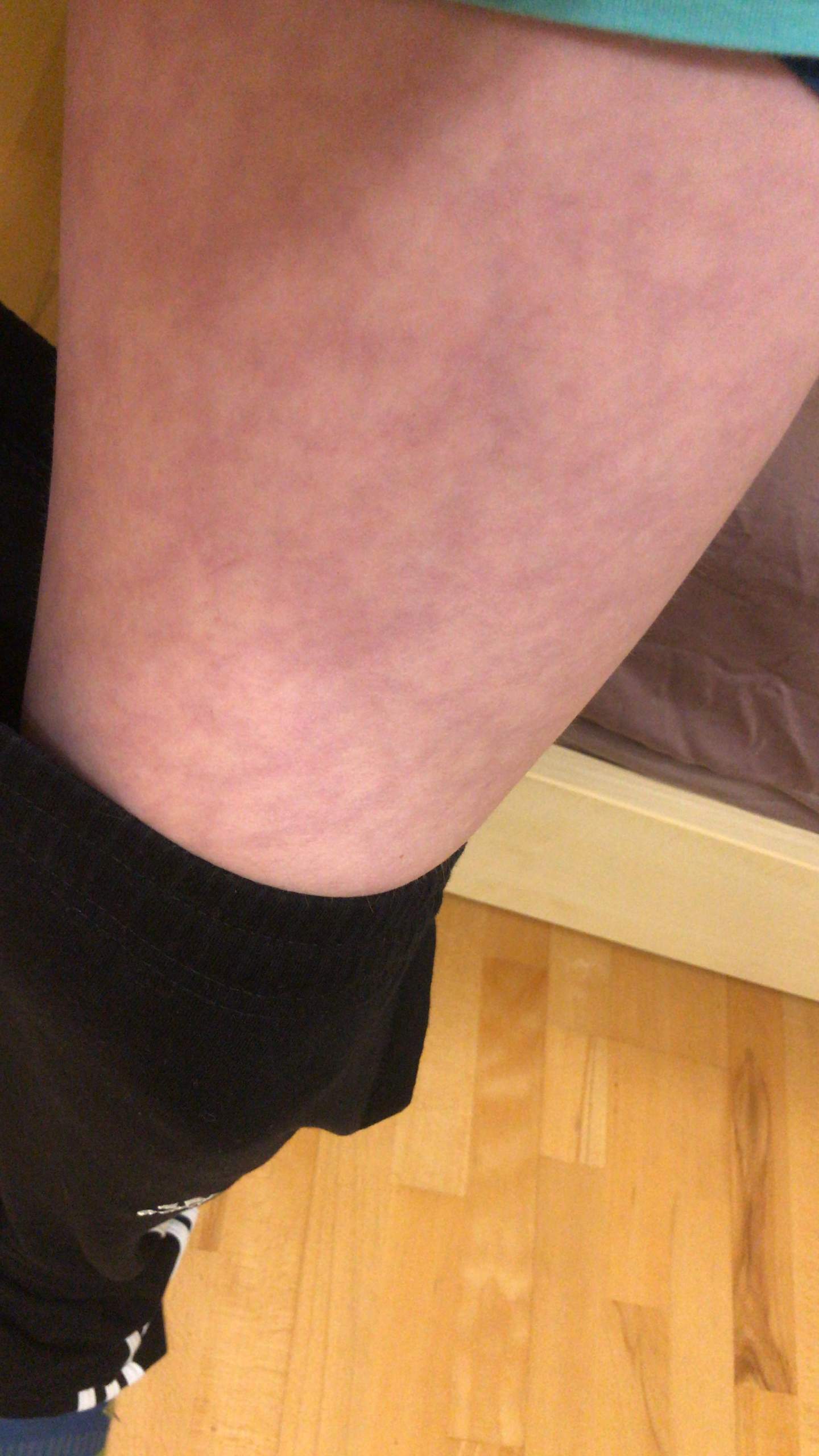 Blaue Flecken am Bein? (Gesundheit und Medizin, blauer Fleck)