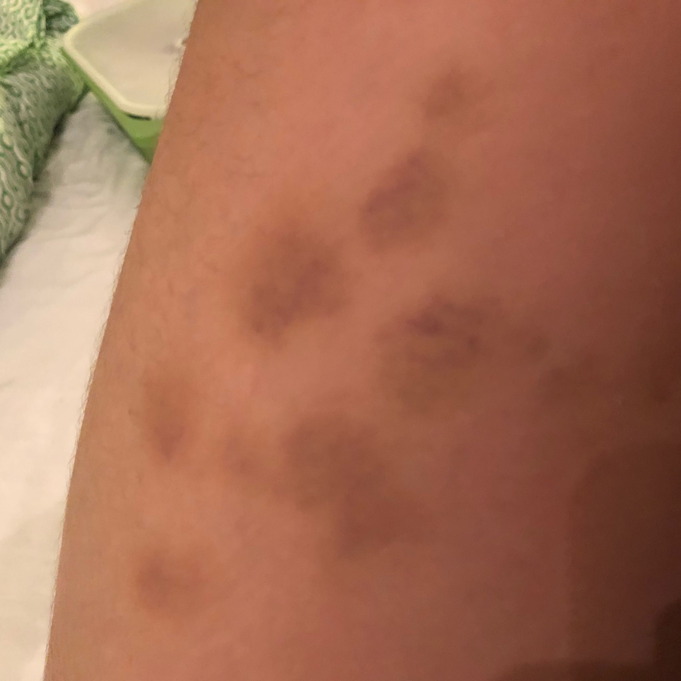 Blaue Flecken Am Oberschenkel Ursache Gesundheit Und Medizin Medizin Korper Blaue Flecken Am Oberschenkel Ursache Gesundheit Und Medizin Medizin Korper