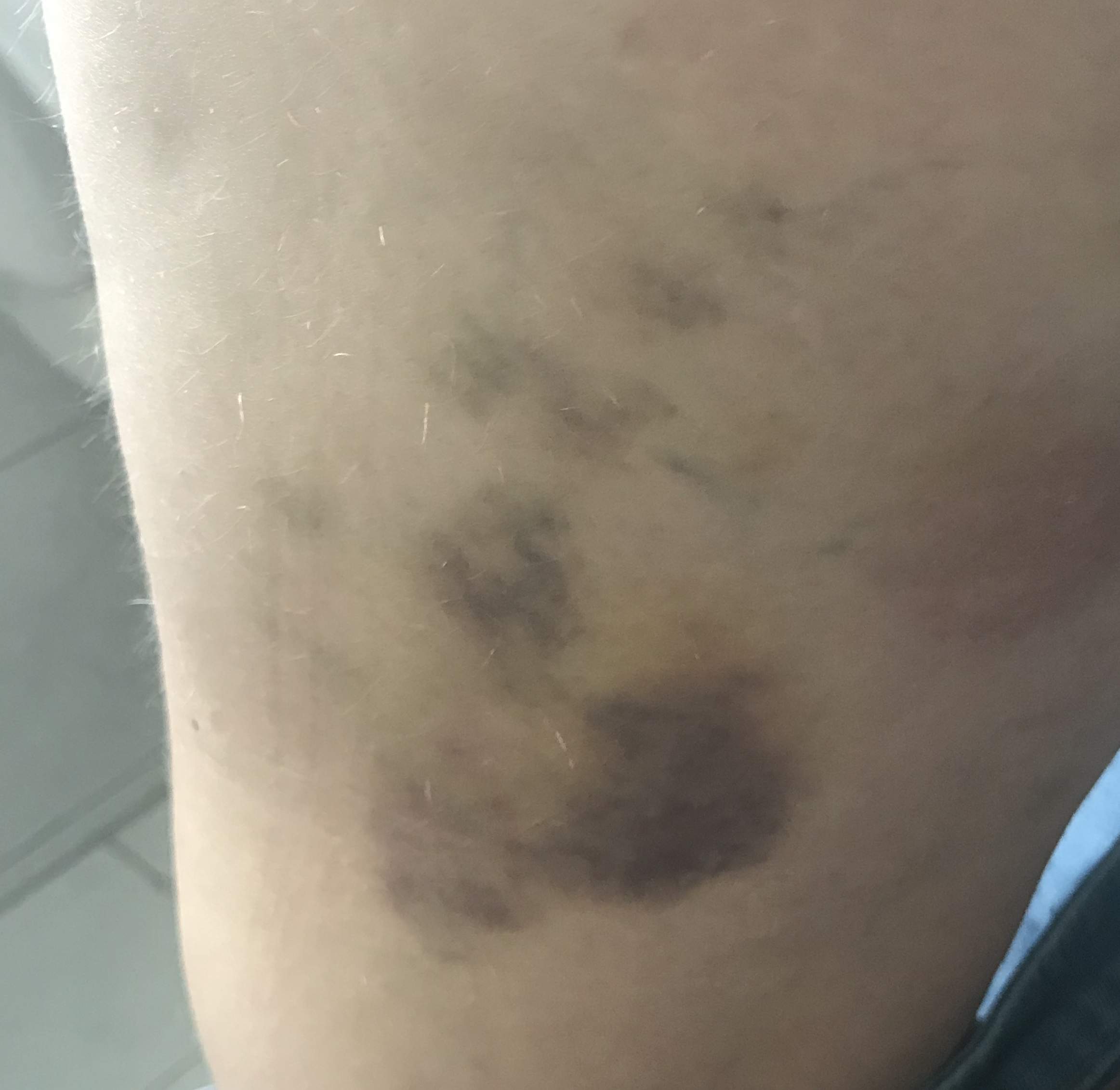 Blaue Flecken an Oberschenkel ohne Grund? (Gesundheit und Medizin