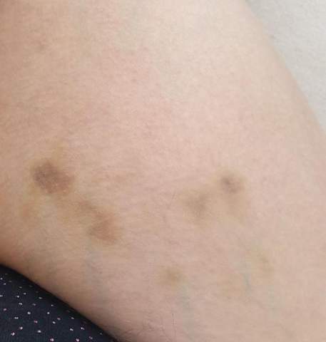 Blaue Flecken Angst Vor Leukamie Blaue Flecken Angst Vor Leukamie