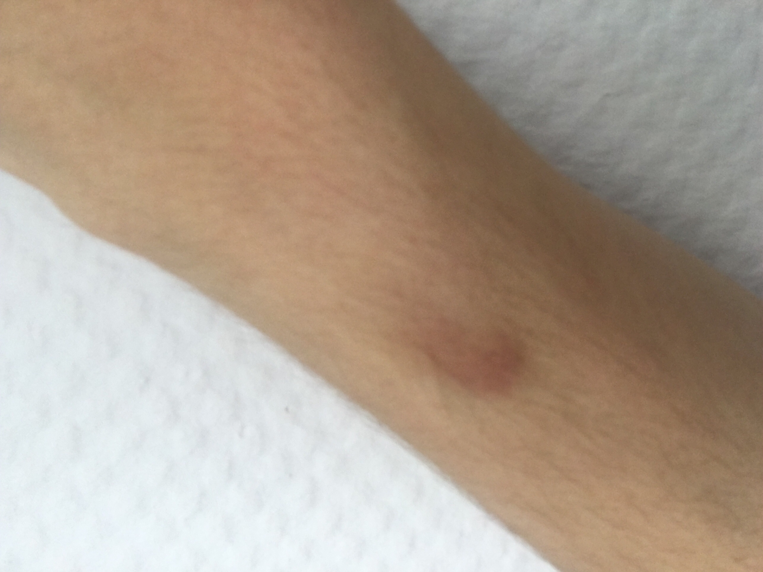 Blaue Flecken aus dem nichts was soll ich machen, was kann das sein