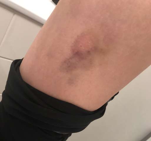 Blaue Flecken durch Mückenstich? (Gesundheit und Medizin, Medizin ...