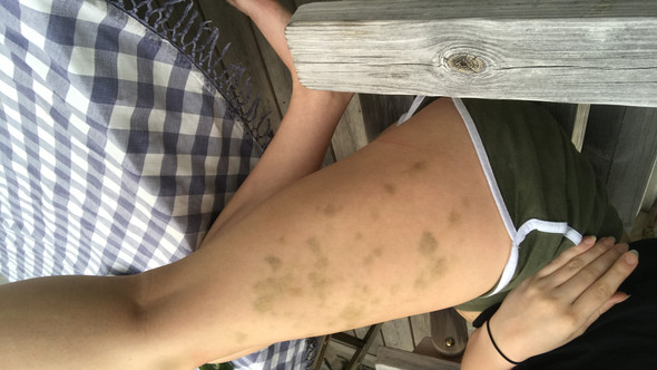 Blaue Flecken Uber Nacht Mudigkeit Und Schwache Gesundheit Und Medizin Blaue Flecken Blaue Flecken Uber Nacht Mudigkeit Und Schwache Gesundheit Und Medizin Blaue Flecken