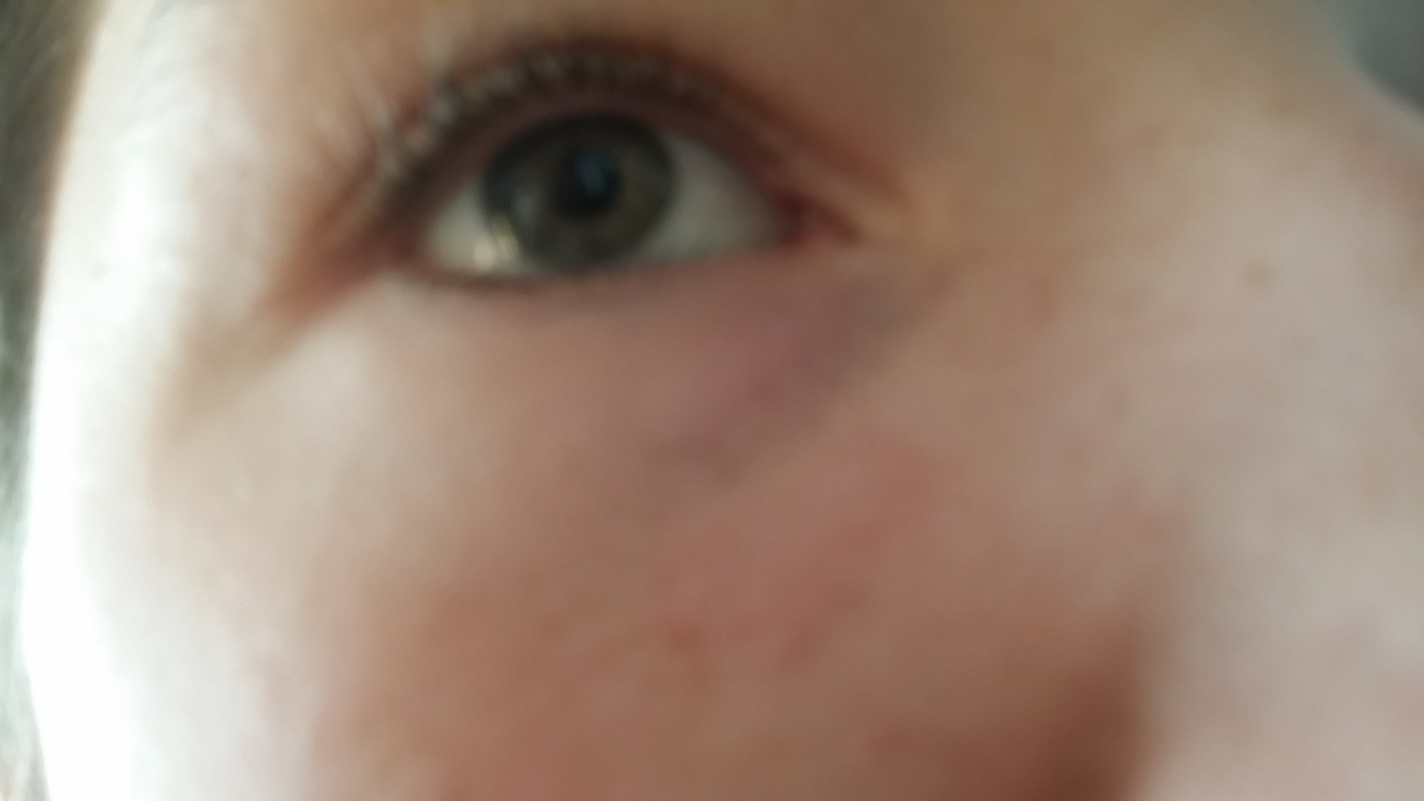 Warum habe ich blaue Flecken unter