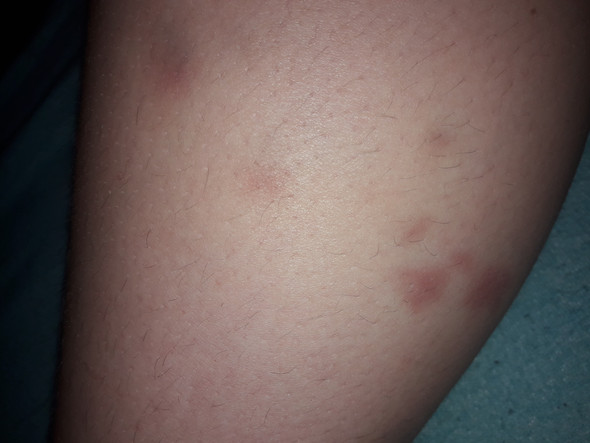 Blaue Flecken?Sorgen? (Gesundheit und Medizin, Was tun, Blauer fleck)