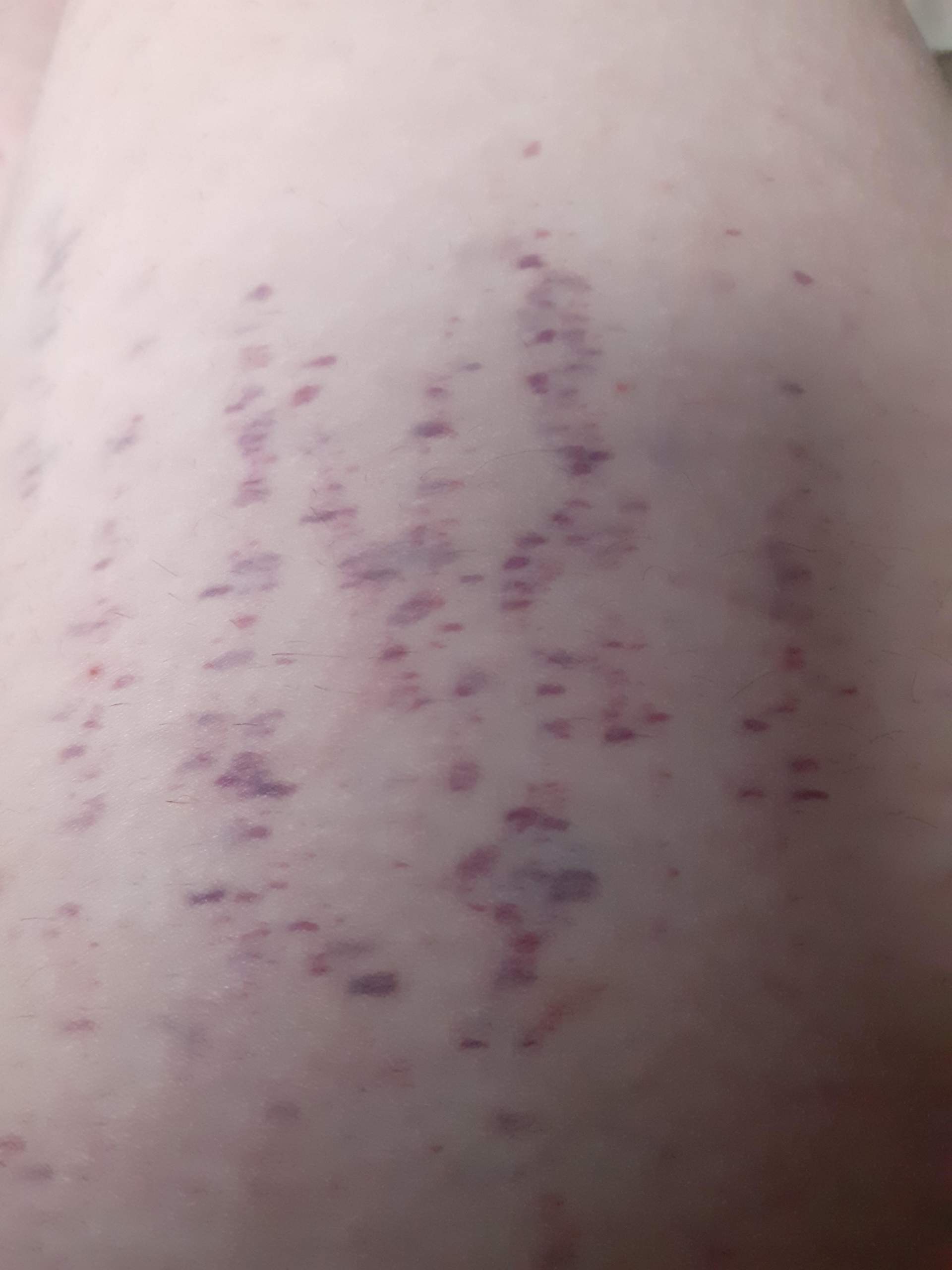 Blaue lila Flecke am beim? (Gesundheit und Medizin, blauer Fleck) Blaue lila Flecke am beim? (Gesundheit und Medizin, blauer Fleck)