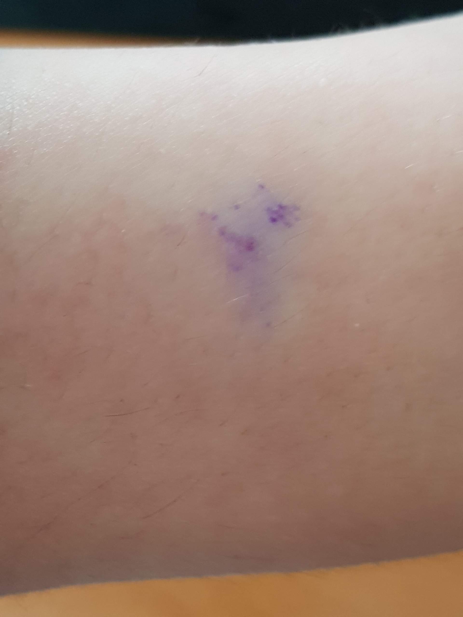 Blaue Punkte unter der Haut! was kann das sein? (Gesundheit, Körper