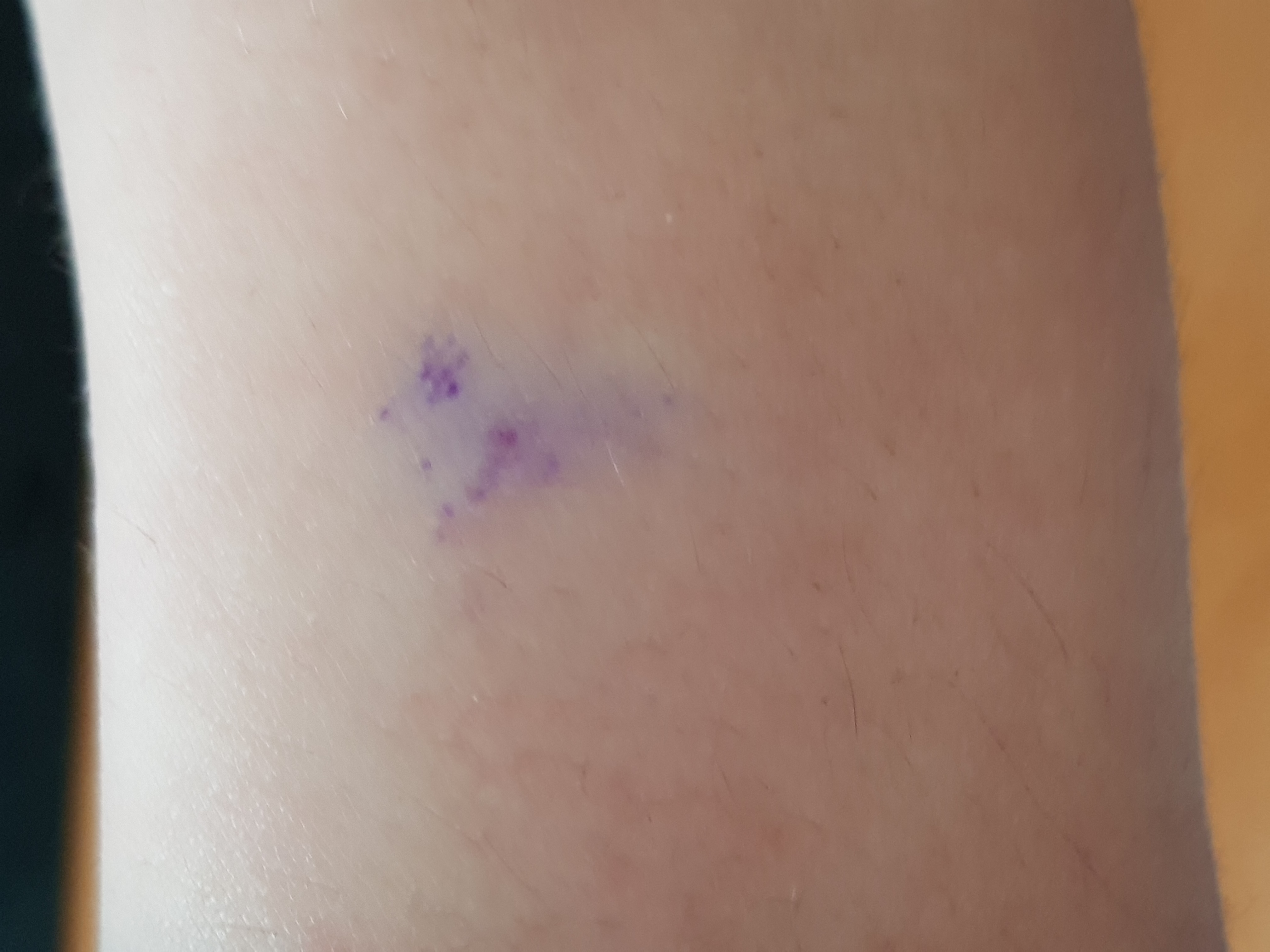 Blauer Fleck Geht Nicht Weg Forum Blaue Punkte unter der Haut! was kann das sein? (Gesundheit, Körper