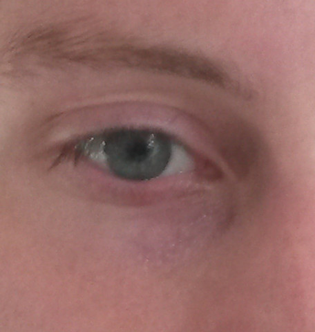 Blaue Und Rote Adern Am Auge Wie Bekomme Sie Weg Gesundheit Augen Gesicht