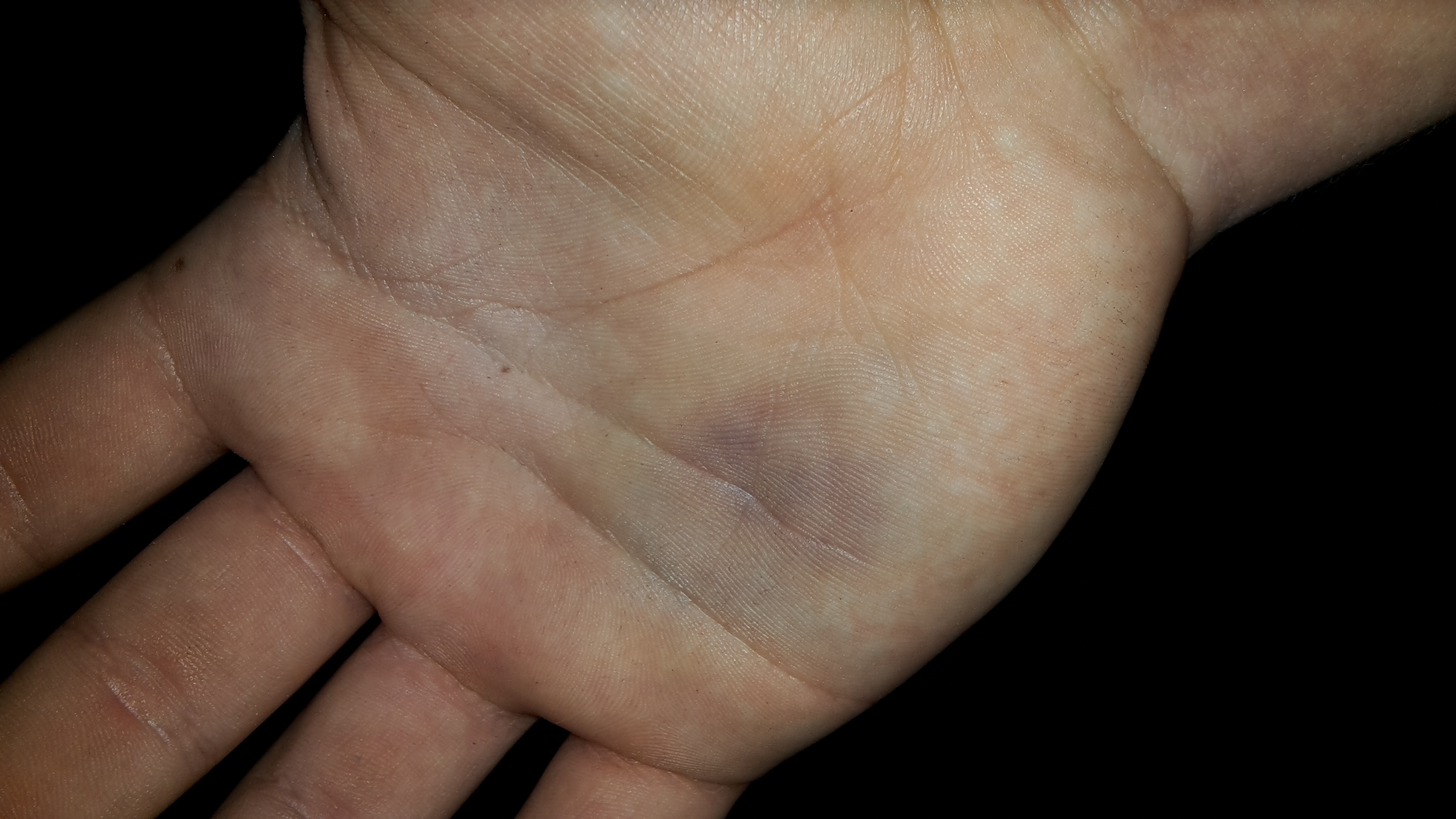 blauer fleck nach blutabnahme - DrBeckmann