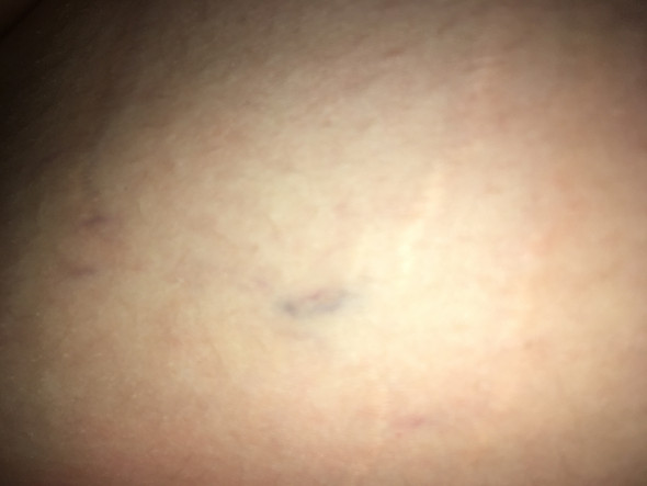 Blauer Fleck Auf Dem Bauch Muskelkater Dehnungsstreifen Blauer Fleck Auf Dem Bauch Muskelkater Dehnungsstreifen