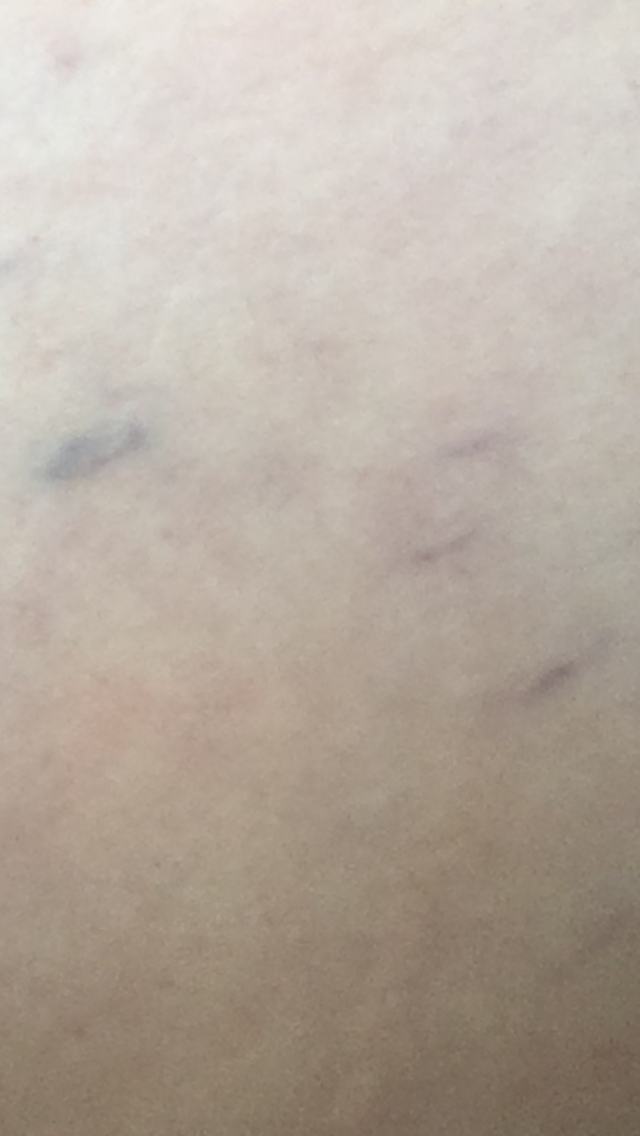 Bauch Fühlt Sich An Wie Blauer Fleck Blauer Fleck auf dem Bauch? (Muskelkater, Dehnungsstreifen)