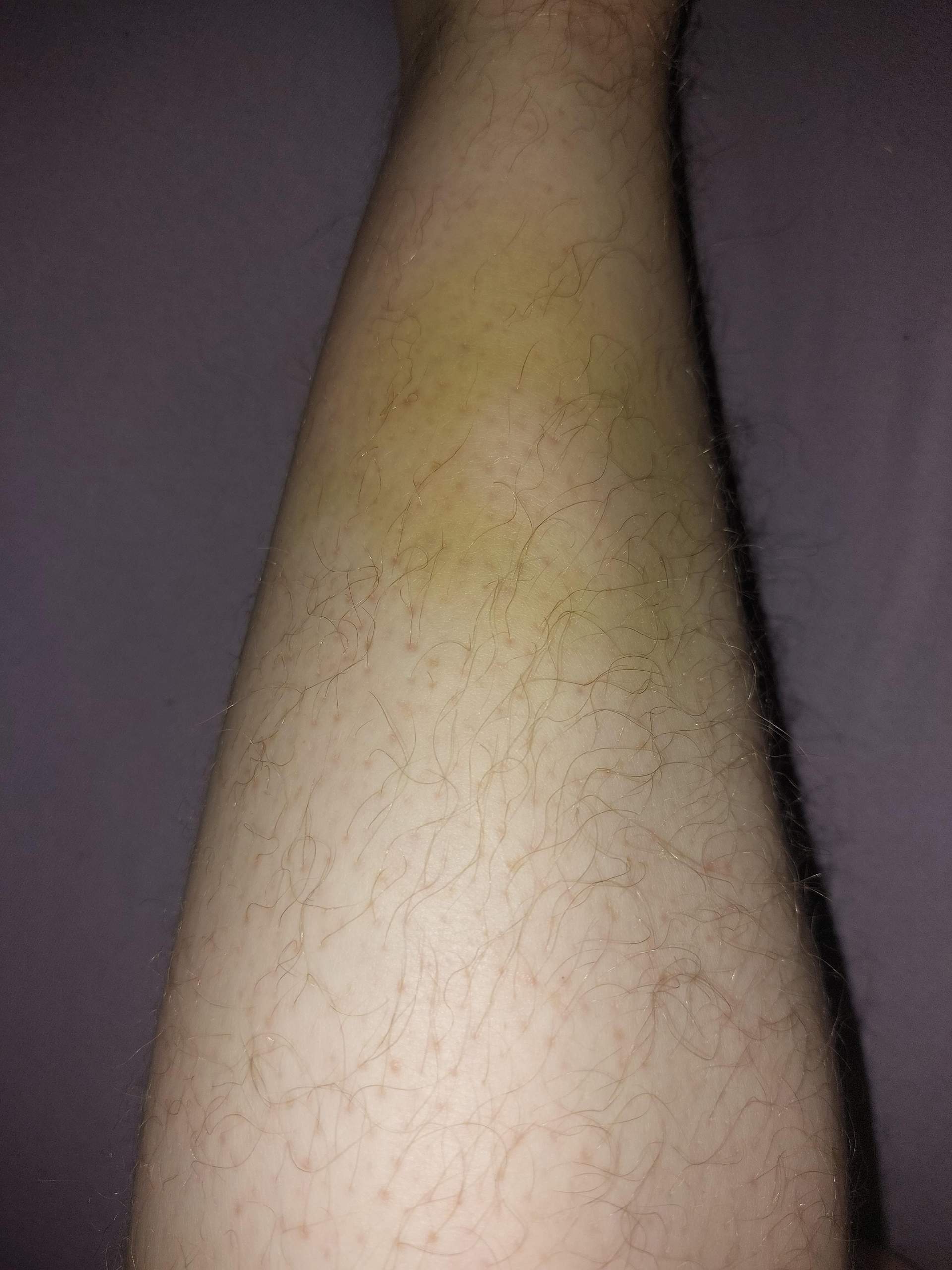 Blauer Fleck geht nicht weg? (jucken, Keine Schmerzen)
