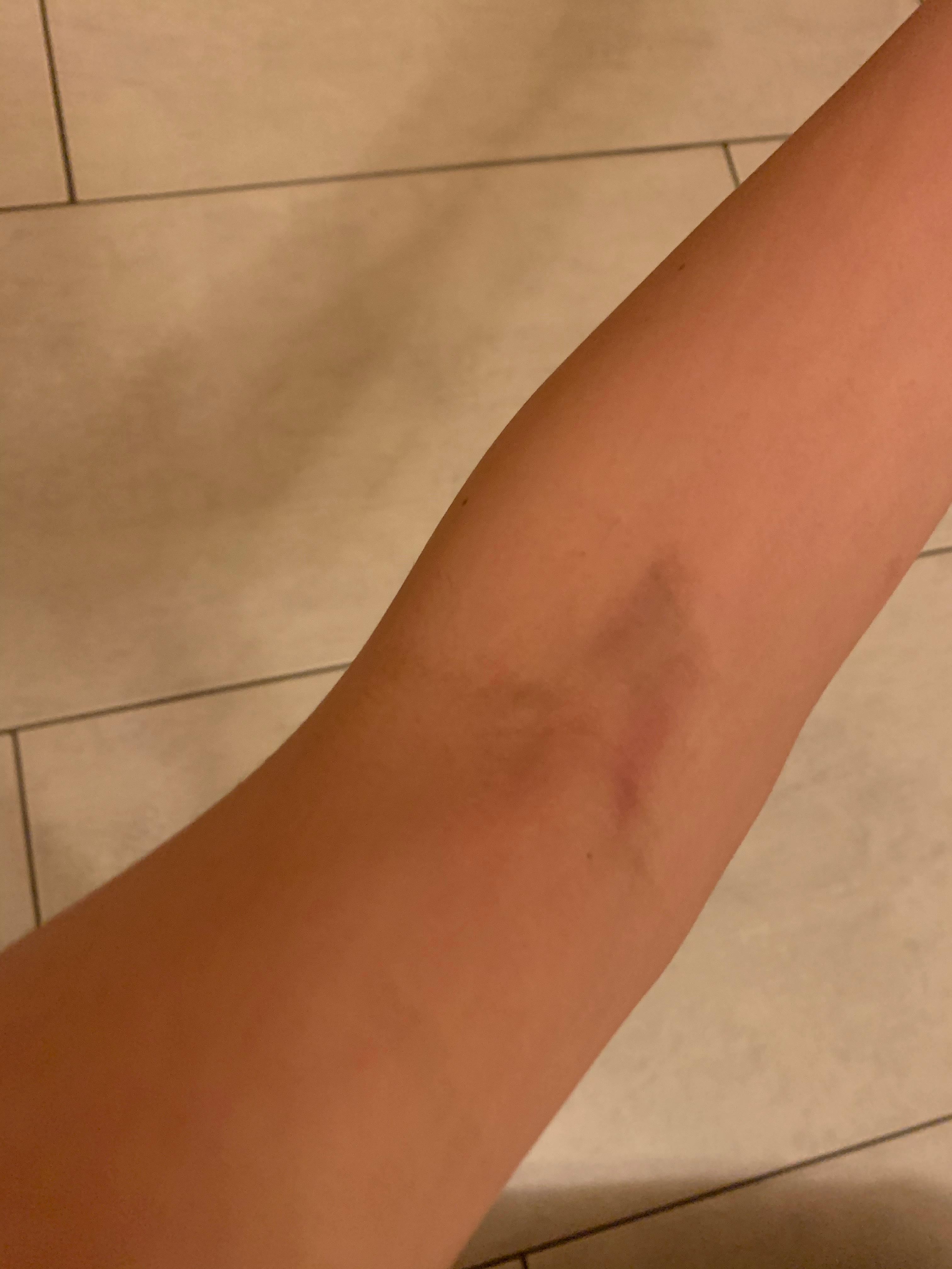 Blauer Fleck Nach Blutabnahme Verandert Sich Gesundheit Und Medizin Blauer Fleck Nach Blutabnahme Verandert Sich Gesundheit Und Medizin
