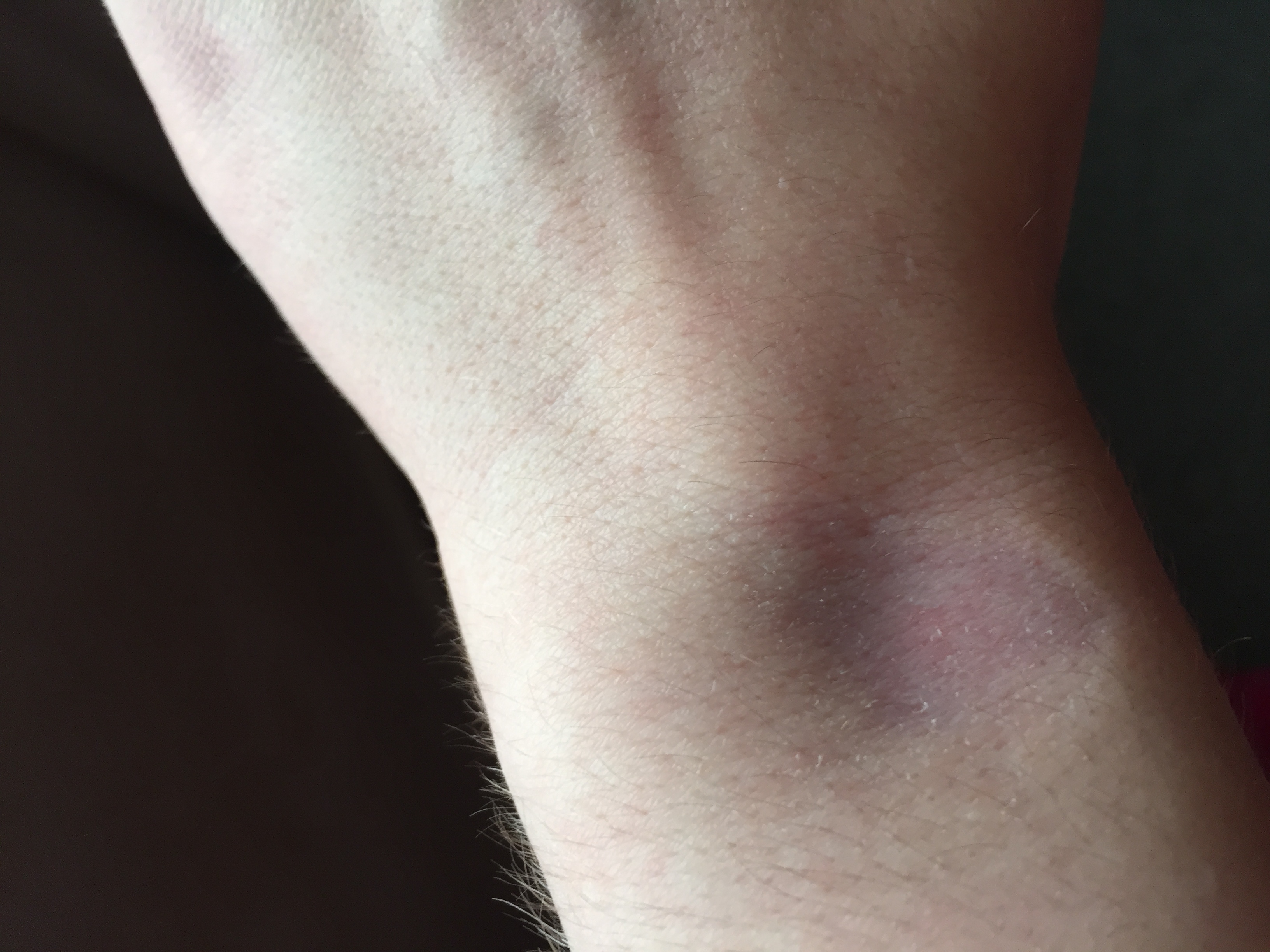 Blauer Fleck Geht Nicht Weg Forum Blauer Fleck nach ganglion Entfernung geht nicht mehr weg ? (Gesundheit