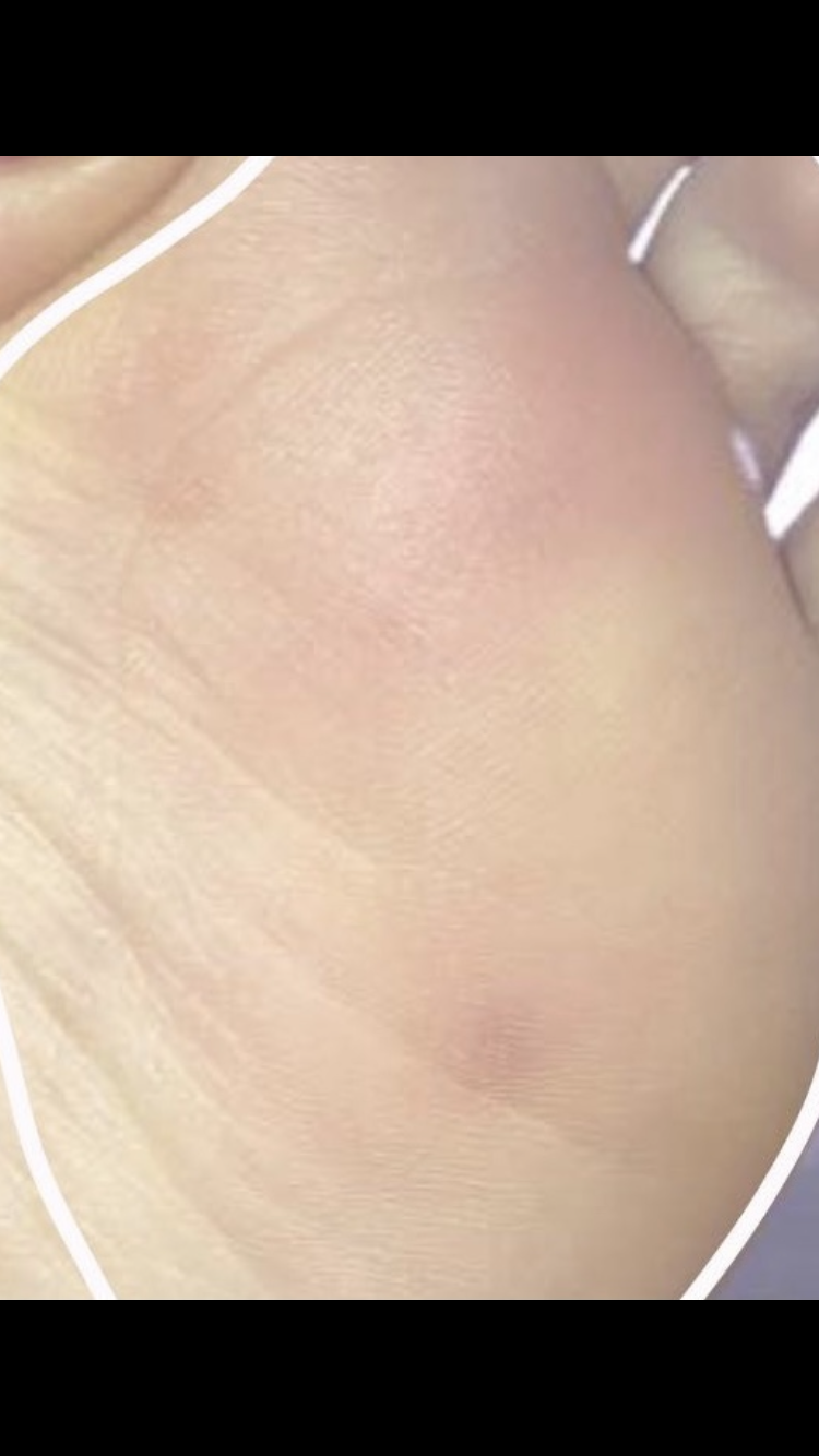Blauer Fleck plötzlich am Fuß? (Gesundheit und Medizin)
