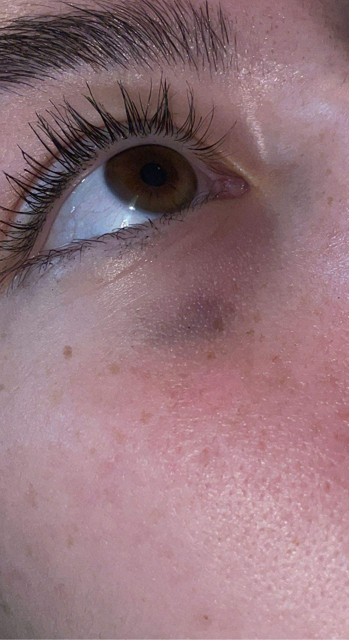 Blauer fleck unterm auge? (Augen)