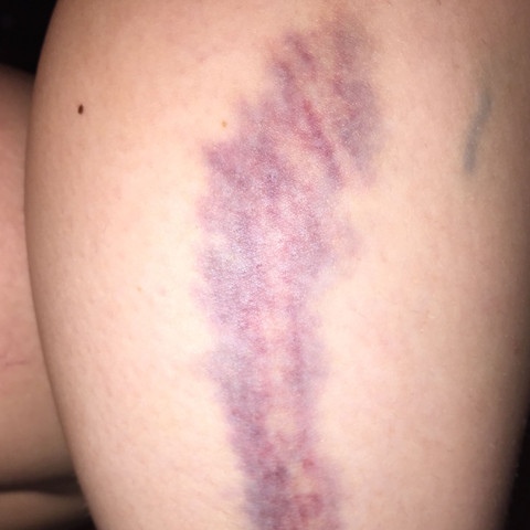 So sieht mein blauer bzw schon lila fleck nach 3 wochen aus - (Blauer fleck, Unterschenkel)