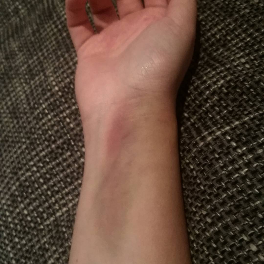 Blauer Fleck wird immer größer , warum ? (Gesundheit, Medizin, Haut)