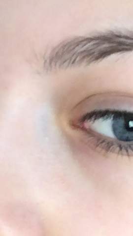 Blauer Fleck Zwischen Auge Und Nase Gesundheit Und Medizin Augen Blauer Fleck Zwischen Auge Und Nase Gesundheit Und Medizin Augen