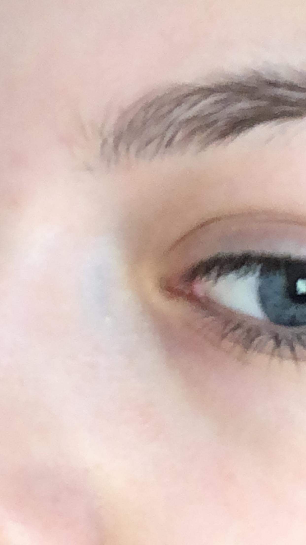 Beule Zwischen Nase Und Auge