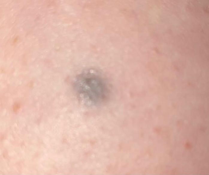 Blauer Fleck Geht Nicht Weg Forum