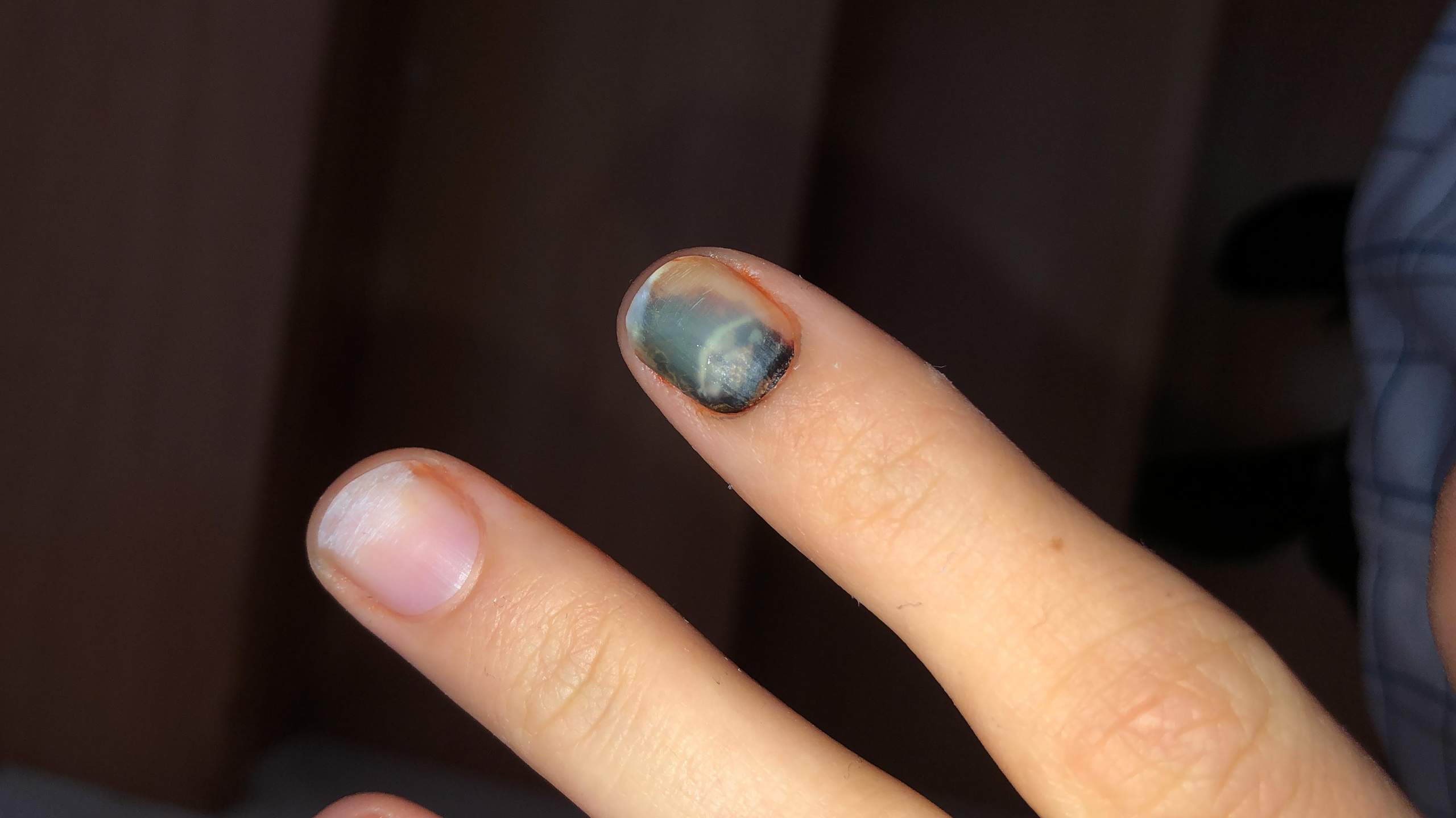 Blauer Nagel..Wann fällt er ab? (eingeklemmt)