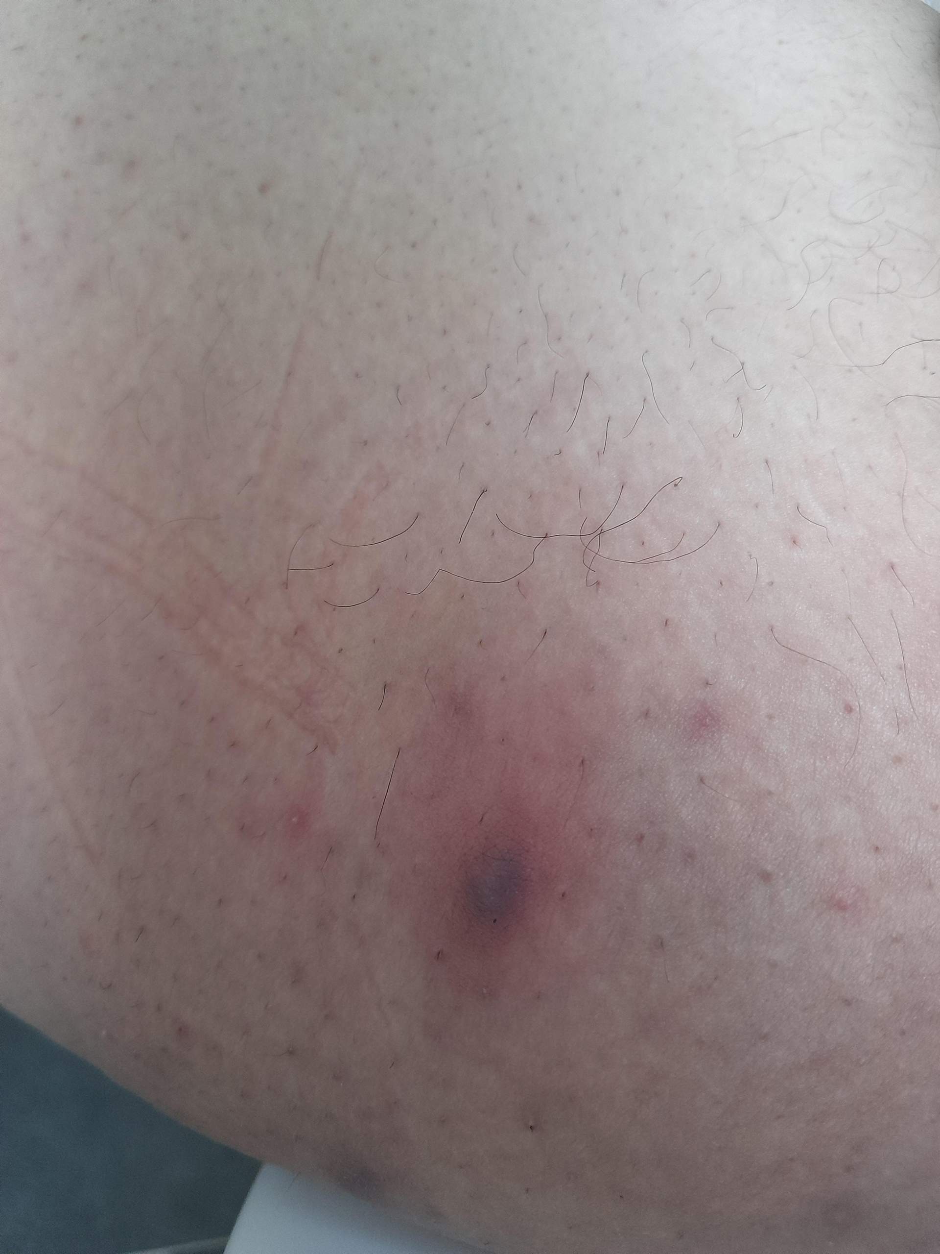 Blauer Pickel am inneren Oberschenkel Was ist das? Hilfe? (Gesundheit und Medizin, Haut) pickel an oberschenkel