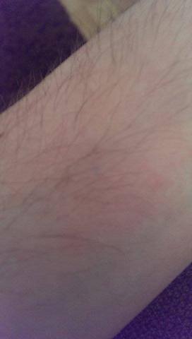 - (Haut, Flecken)