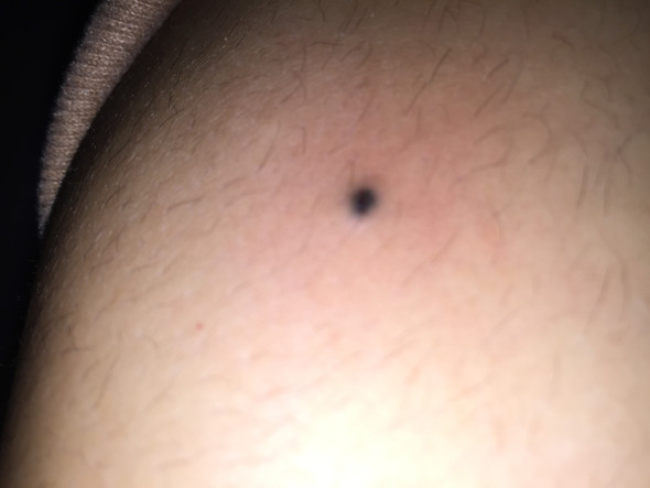 Blauer punkt (Fleck) auf meinem arm? ?Hallo unswar habe ich seit Monaten diesen Muttermal auf ...