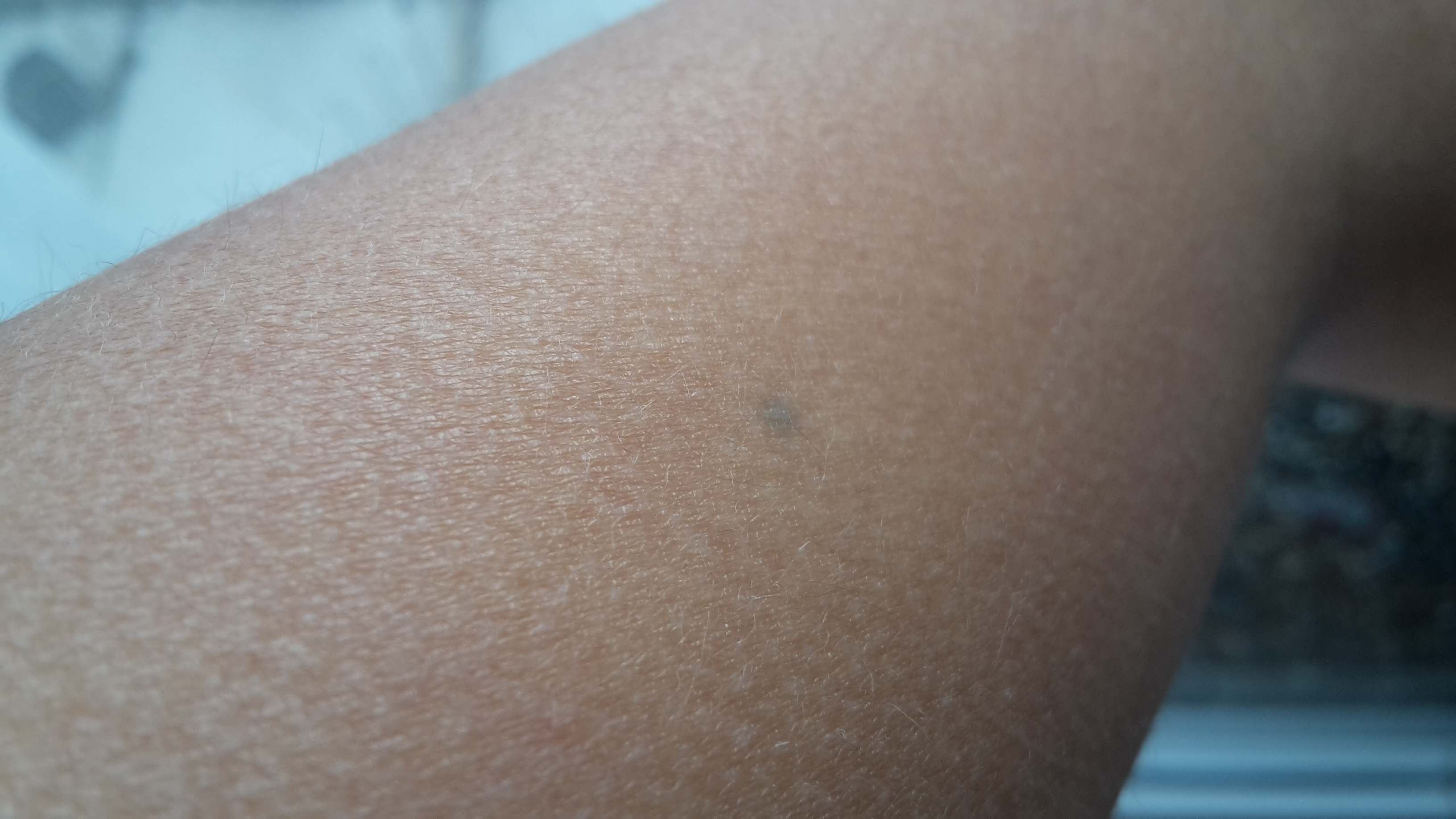 Blauer Punkt unter der Haut? (Gesundheit)