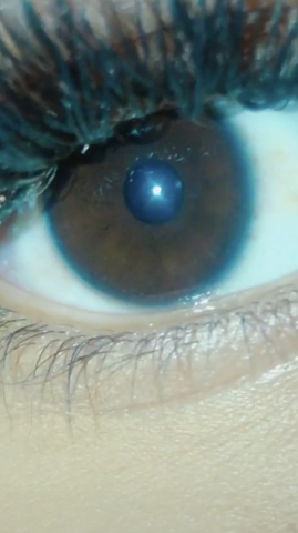Um dunkler iris rand Augendiagnostik: Krankheitssymptome