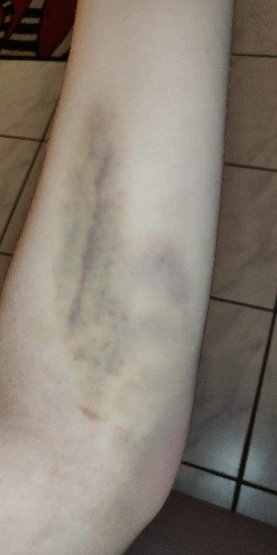 Blauer Streifen nach Blutabnahme? (Gesundheit und Medizin, Gesundheit, Medizin) Blauer Streifen nach Blutabnahme? (Gesundheit und Medizin, Gesundheit, Medizin)