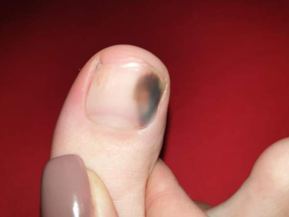 blauer und gelber fleck unter dem nagel gesundheit und medizin bluterguss hautarzt untersuchung