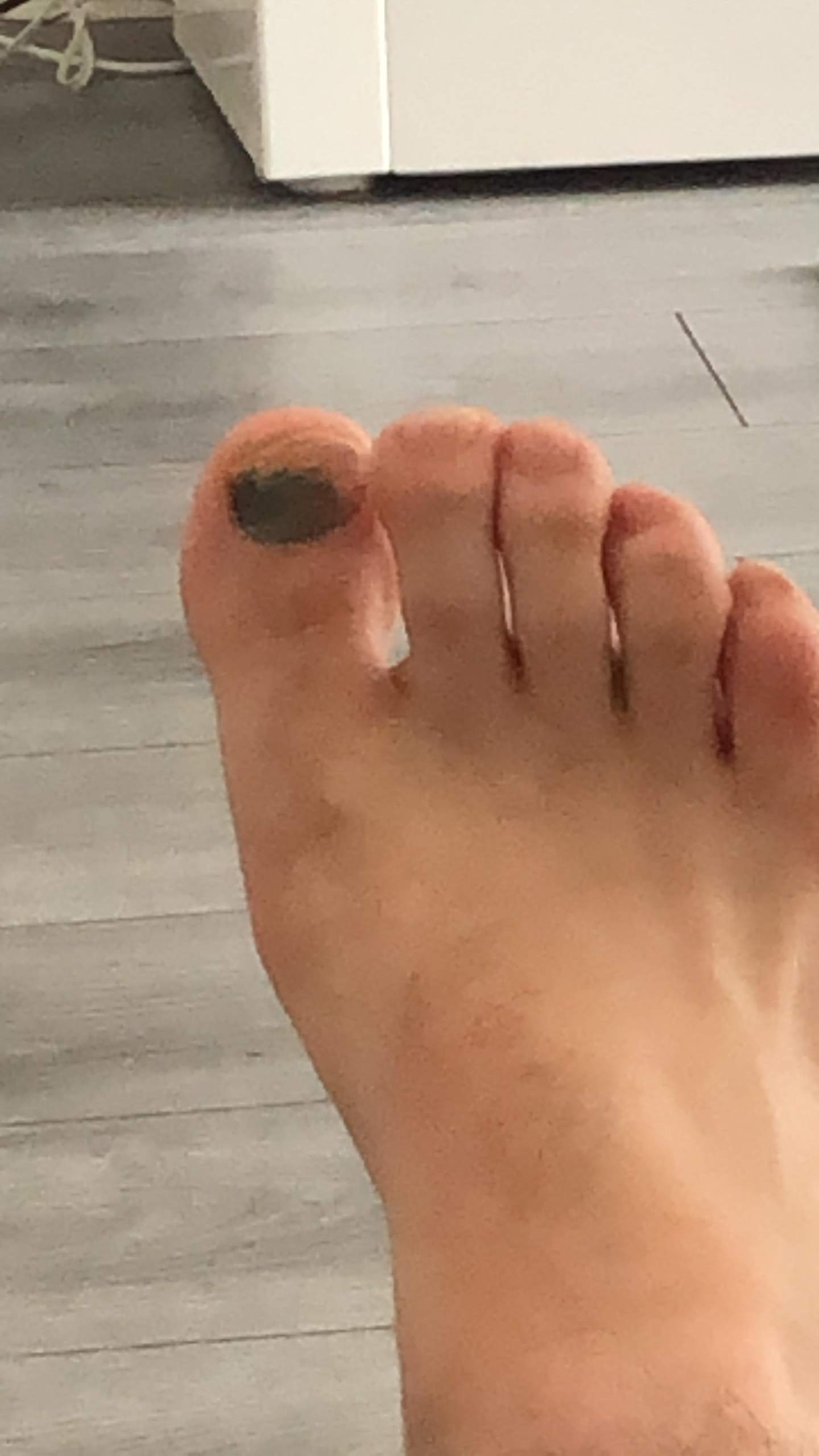 Blauer Zeh. Was tun? (Gesundheit und Medizin)